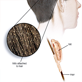 Head lice diagram