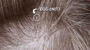 lice egg stuck to hair