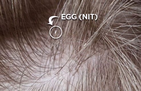 lice egg stuck to hair